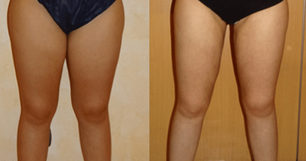 liposuccion cuisses avant apres