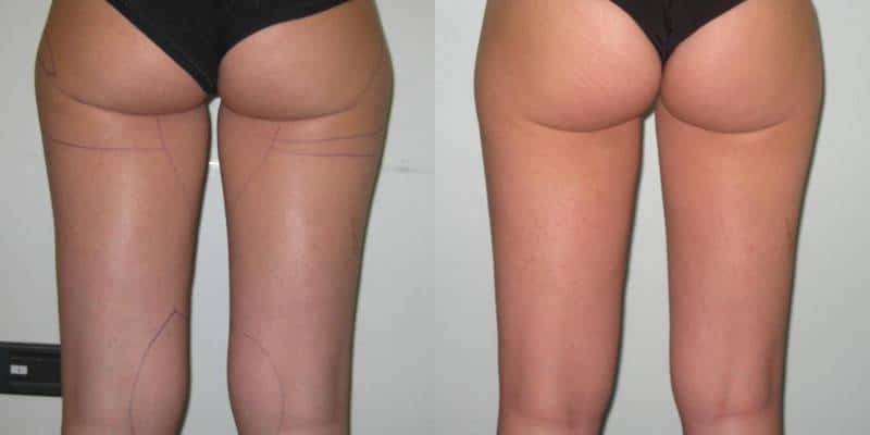 liposuccion hanches et culotte de cheval