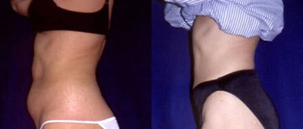 liposuccion ventre tunisie